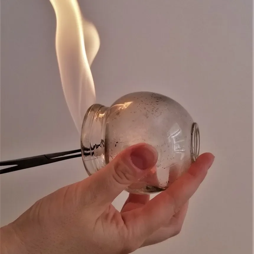 Fire Cupping Services London Ontario