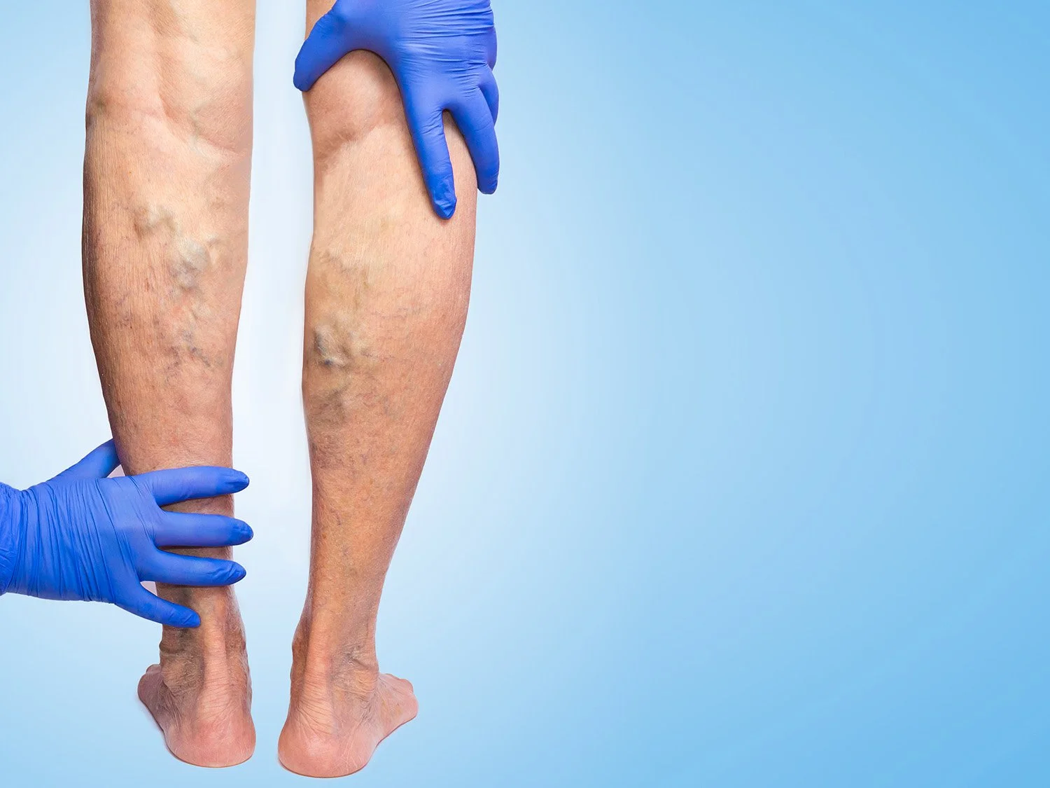 Close-up of elderly person's legs with varicose veins, held by a healthcare professional wearing blue gloves.