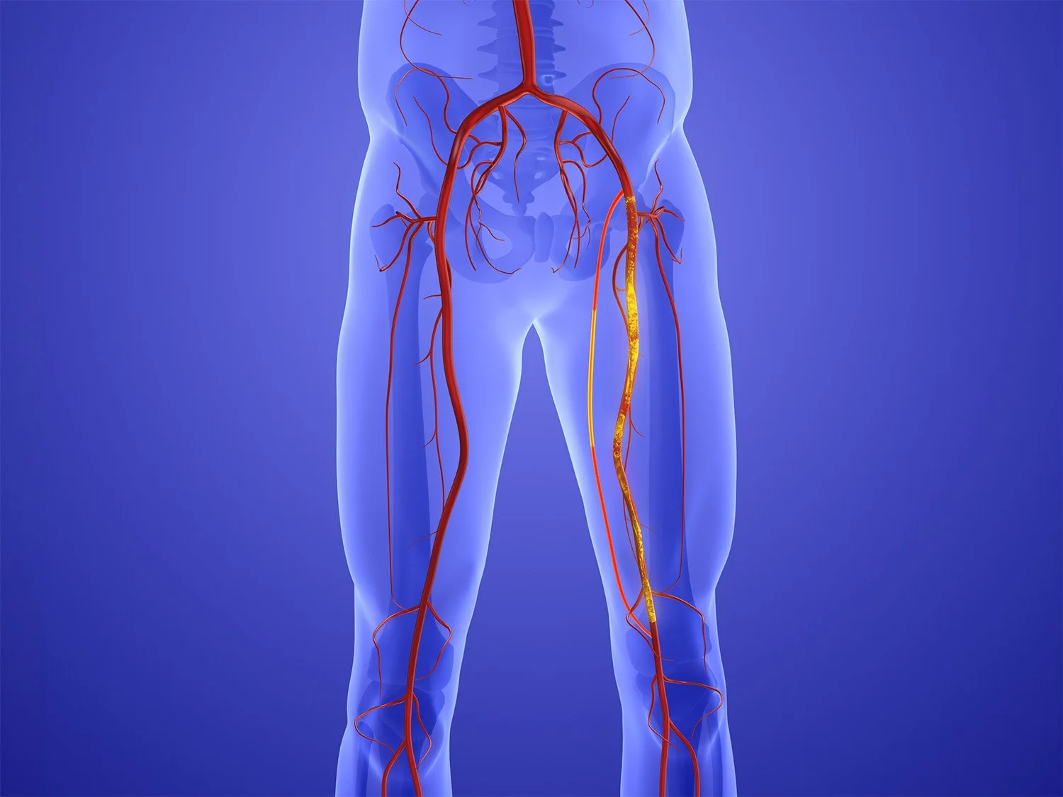 Diagram of the human lower body showing arteries and veins in red and yellow, including the abdominal aorta extending into the leg.