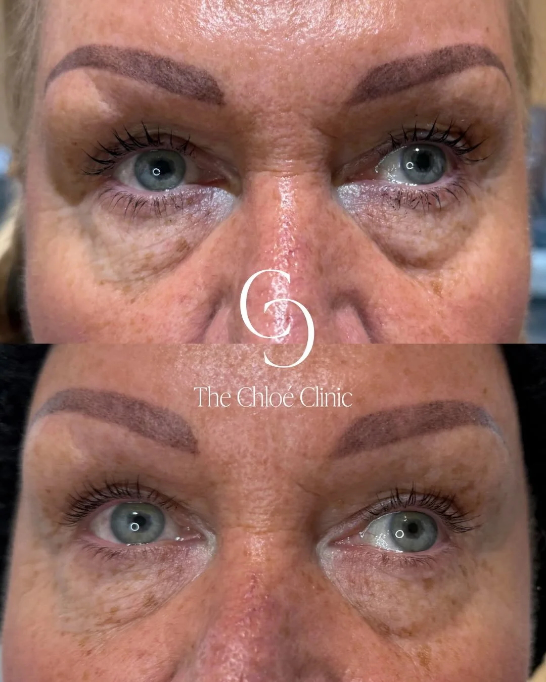 Puffy, tired eyes? Polynucleotides can help! 👁 This powerful treatment works at a cellular level to repair &amp; renew the skin, hydrating, reducing puffiness, and improving skin quality under the eyes - for a fresher, well-rested look ✨

If you&rsq