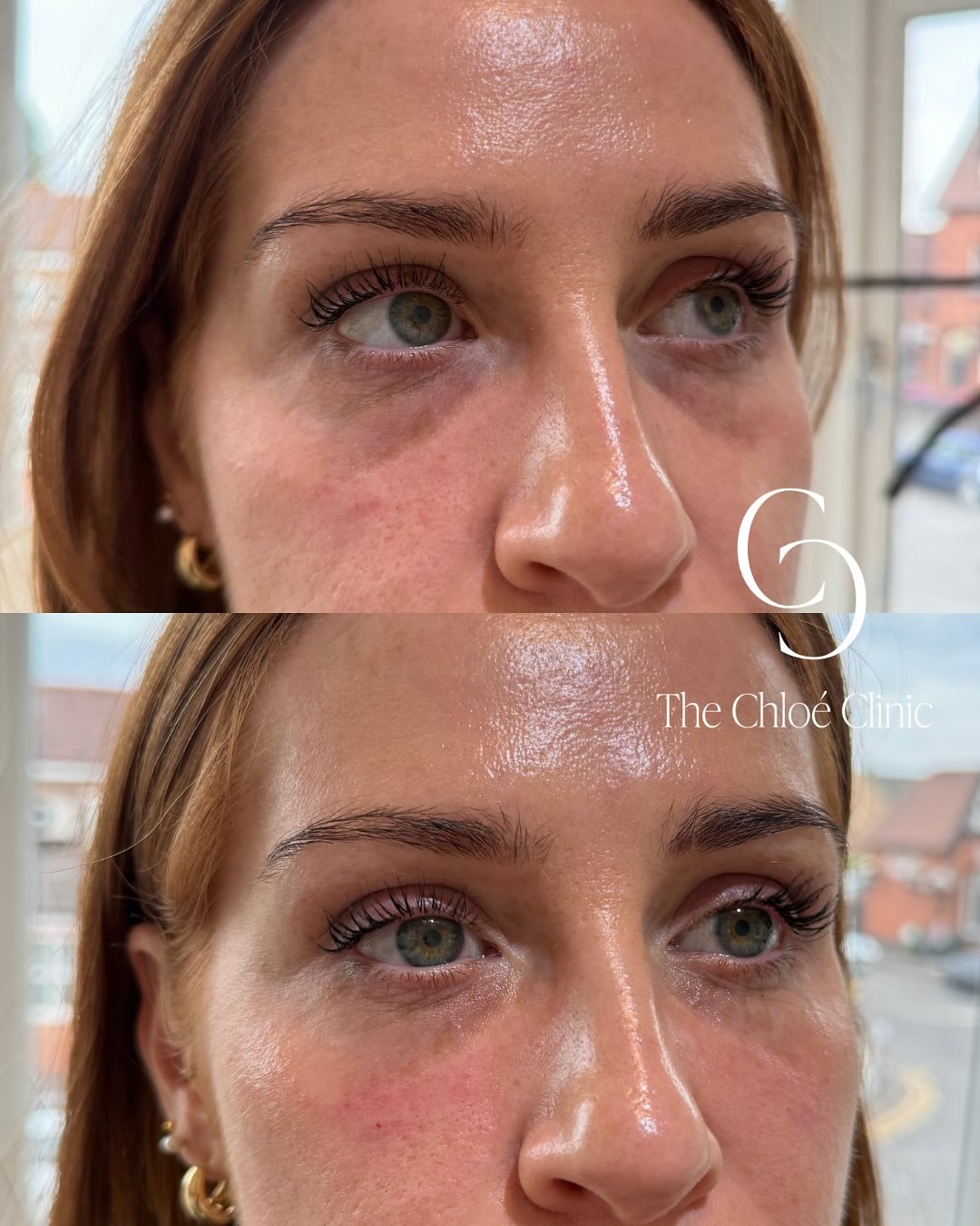One of the most natural treatments that has the most impact to you personally! ✨
Tear trough filler is ideal for brightening tired eyes, reducing dark circles, and restoring under-eye volume. Subtly refreshing the face and helping patients look more 