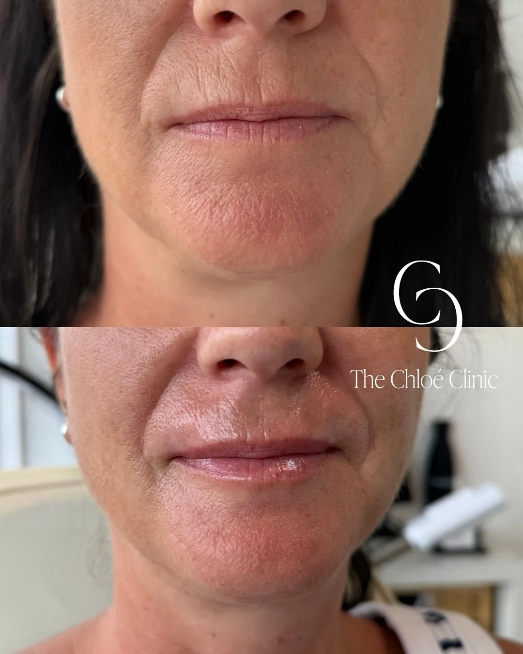 Obsessed 😍 

One of my favourite treatments to perform is softening smoker&rsquo;s lines with a fine, smooth filler. It gives such natural results, but what I love most is the confidence it brings back to my clients they feel refreshed without looki
