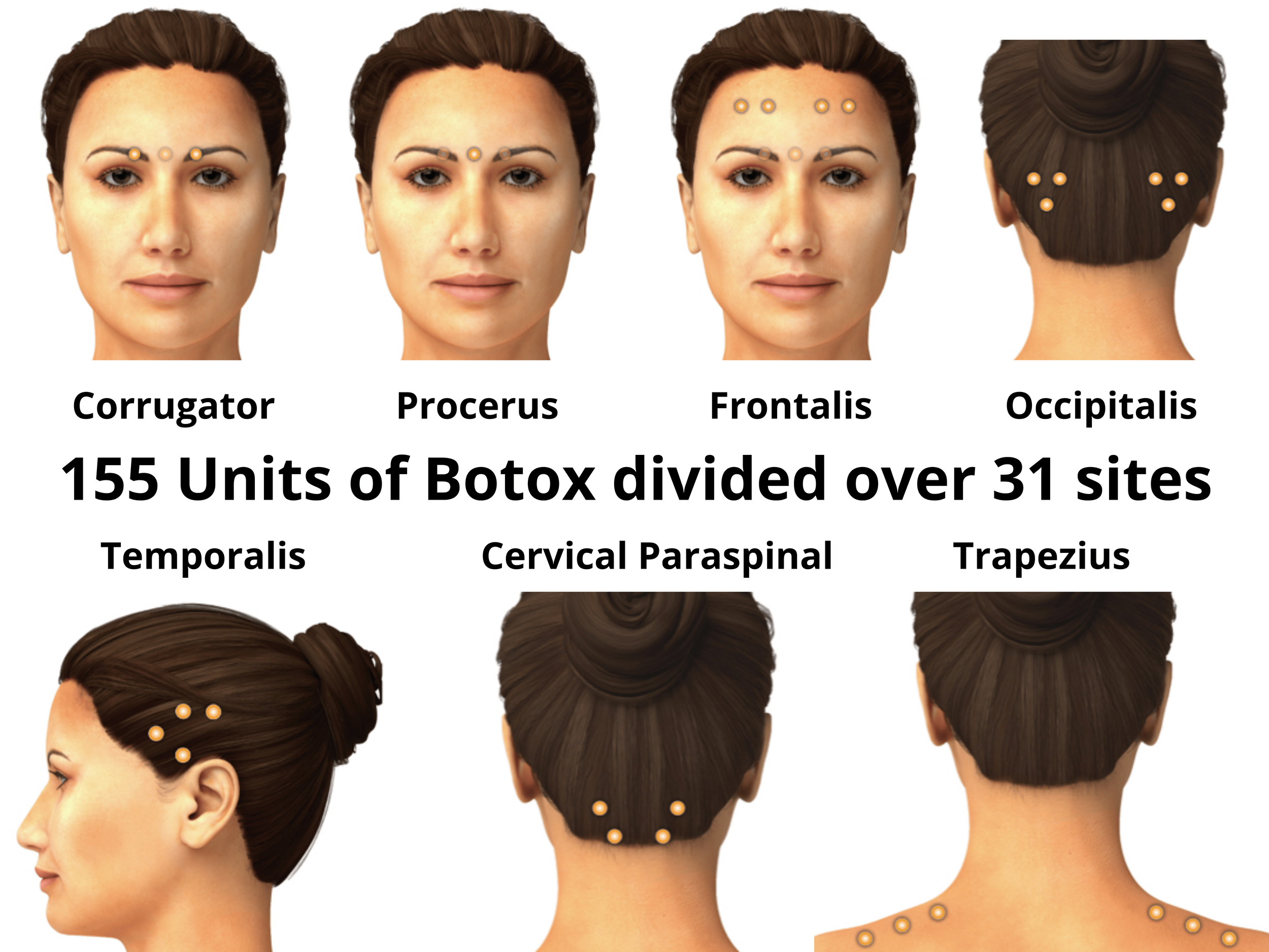 Botox for Migraine in Spokane | Cost, Benefits & Access — Northwest DPC ...