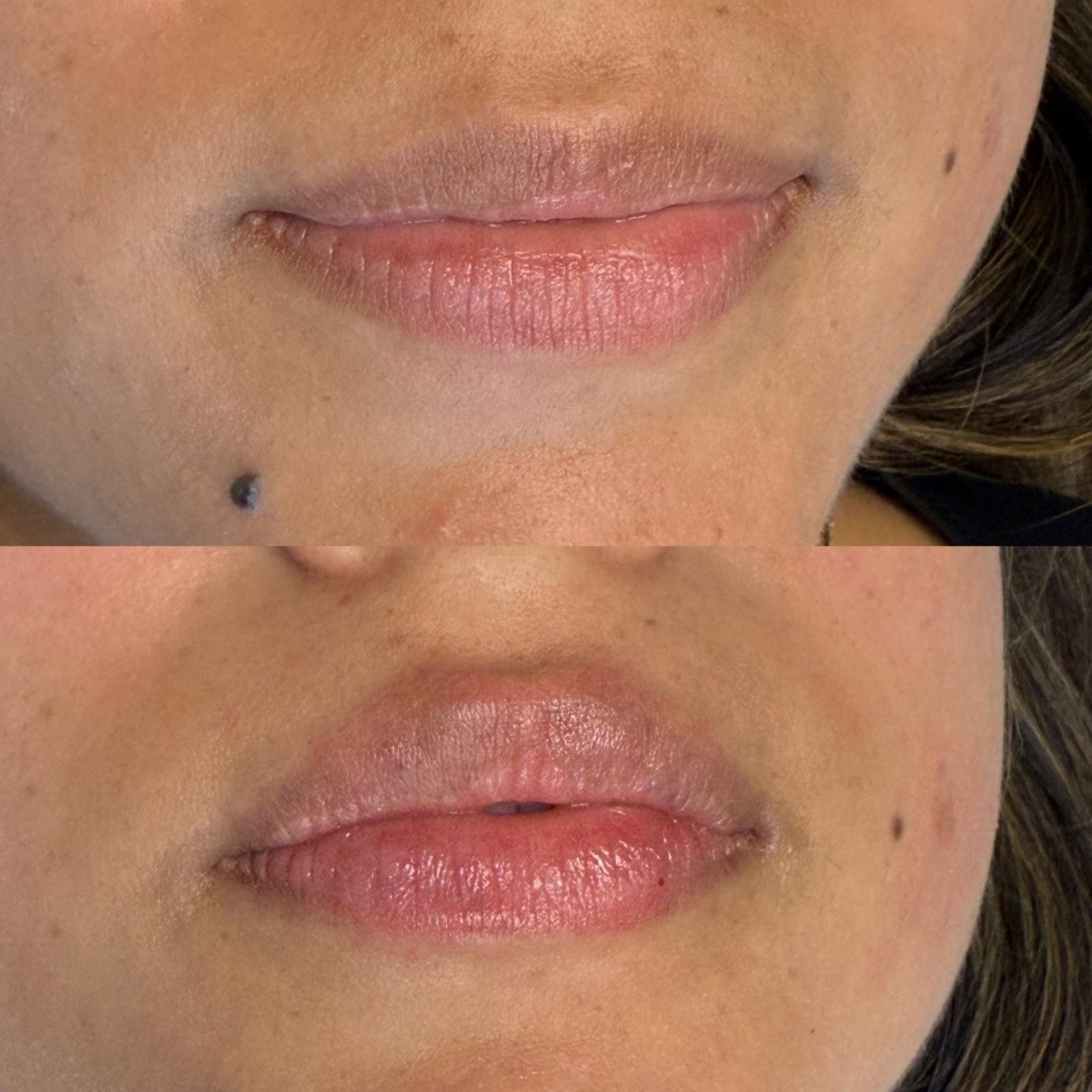 Lip Filler