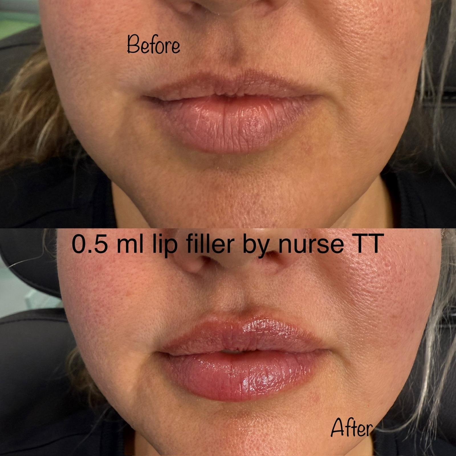 Lip Filler: Before & After