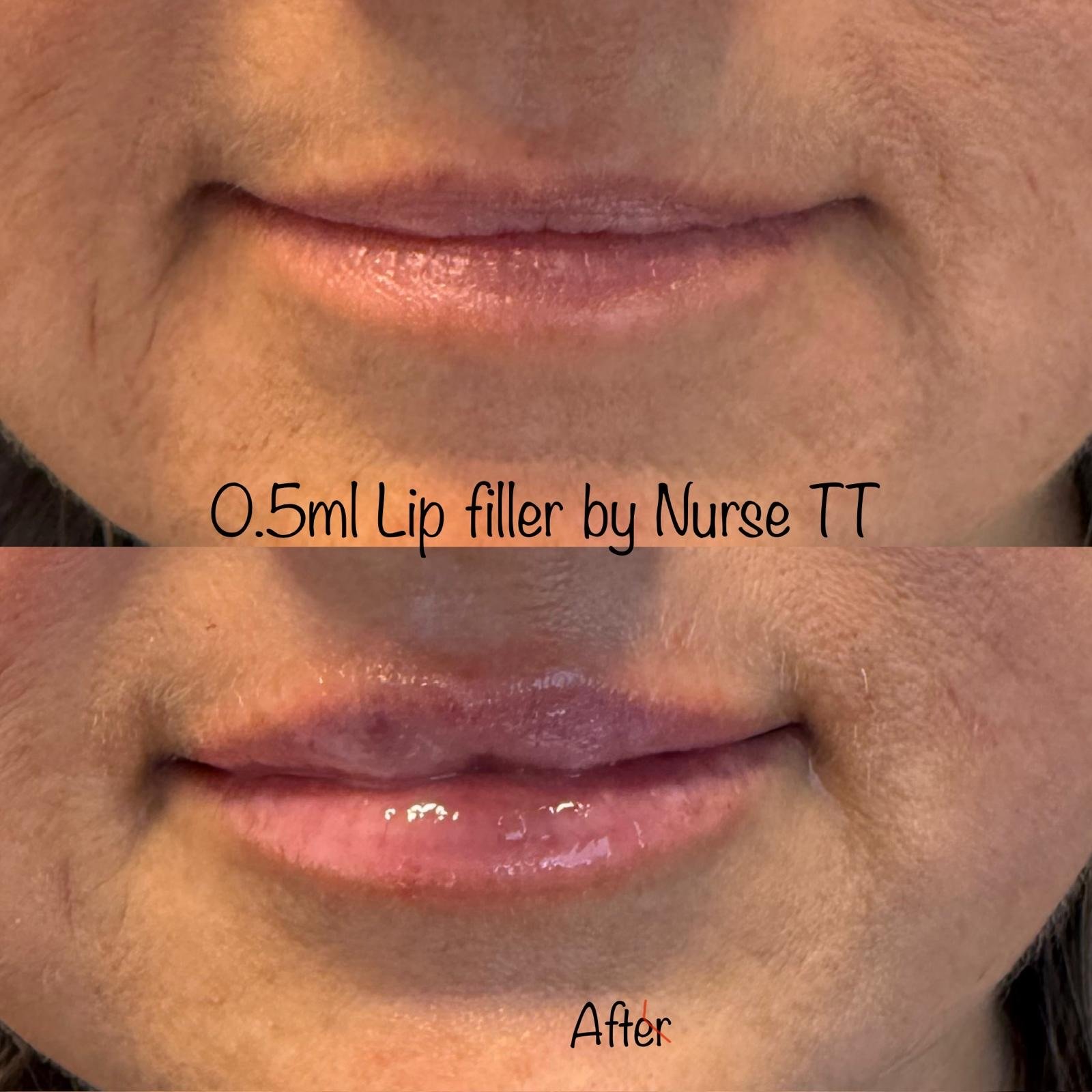 Lip Filler