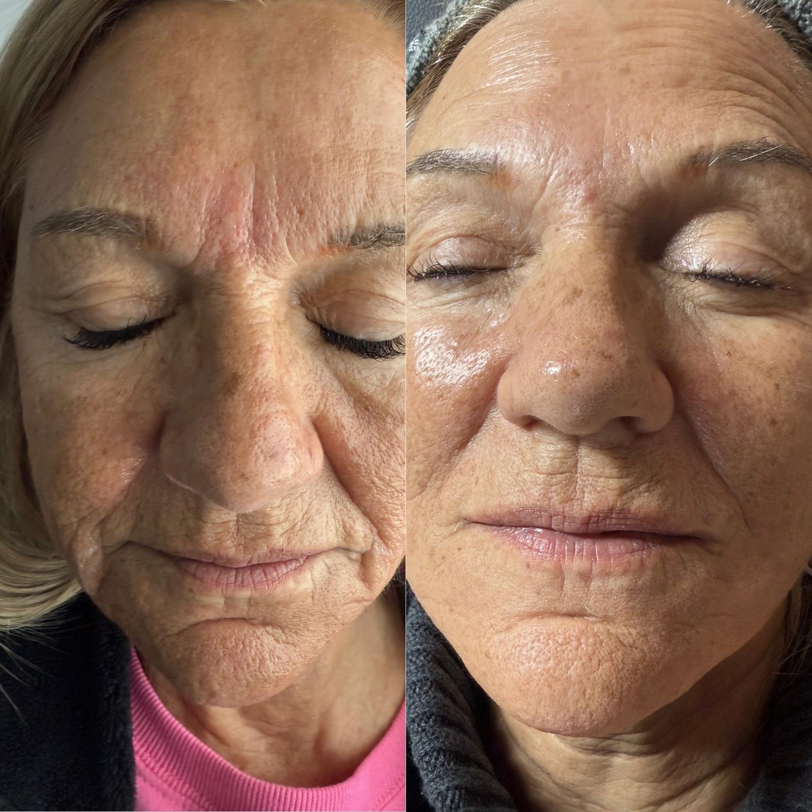 Microneedling
