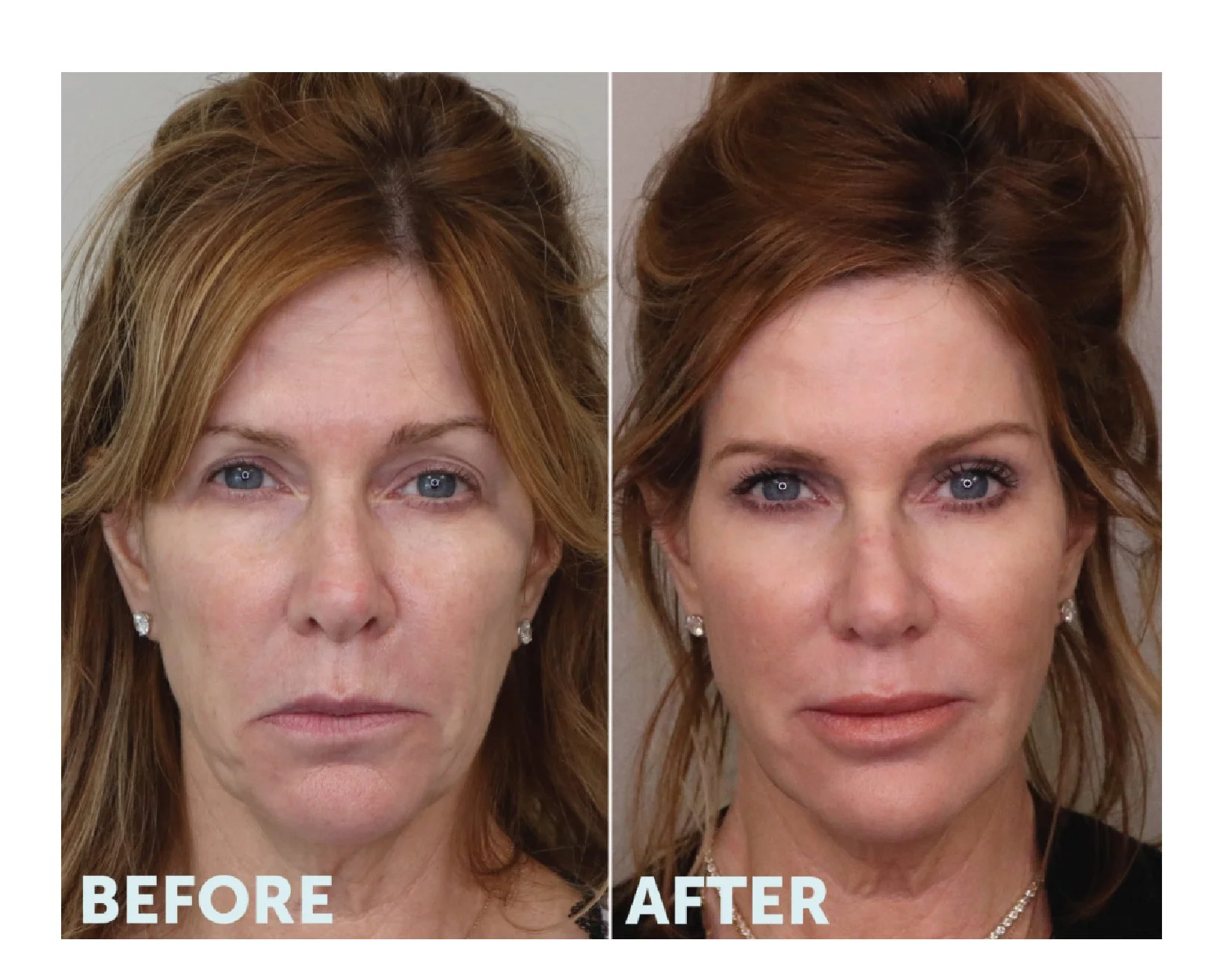Side-by-side comparison showing a woman's face before and after cosmetic treatment, with noticeable improvements in skin smoothness and facial appearance.