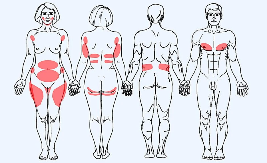 Skizze von männlichen und weiblichen Körpern mit Markierungen in Rot, die Muskelgruppen und Schmerzpunkte anzeigen.