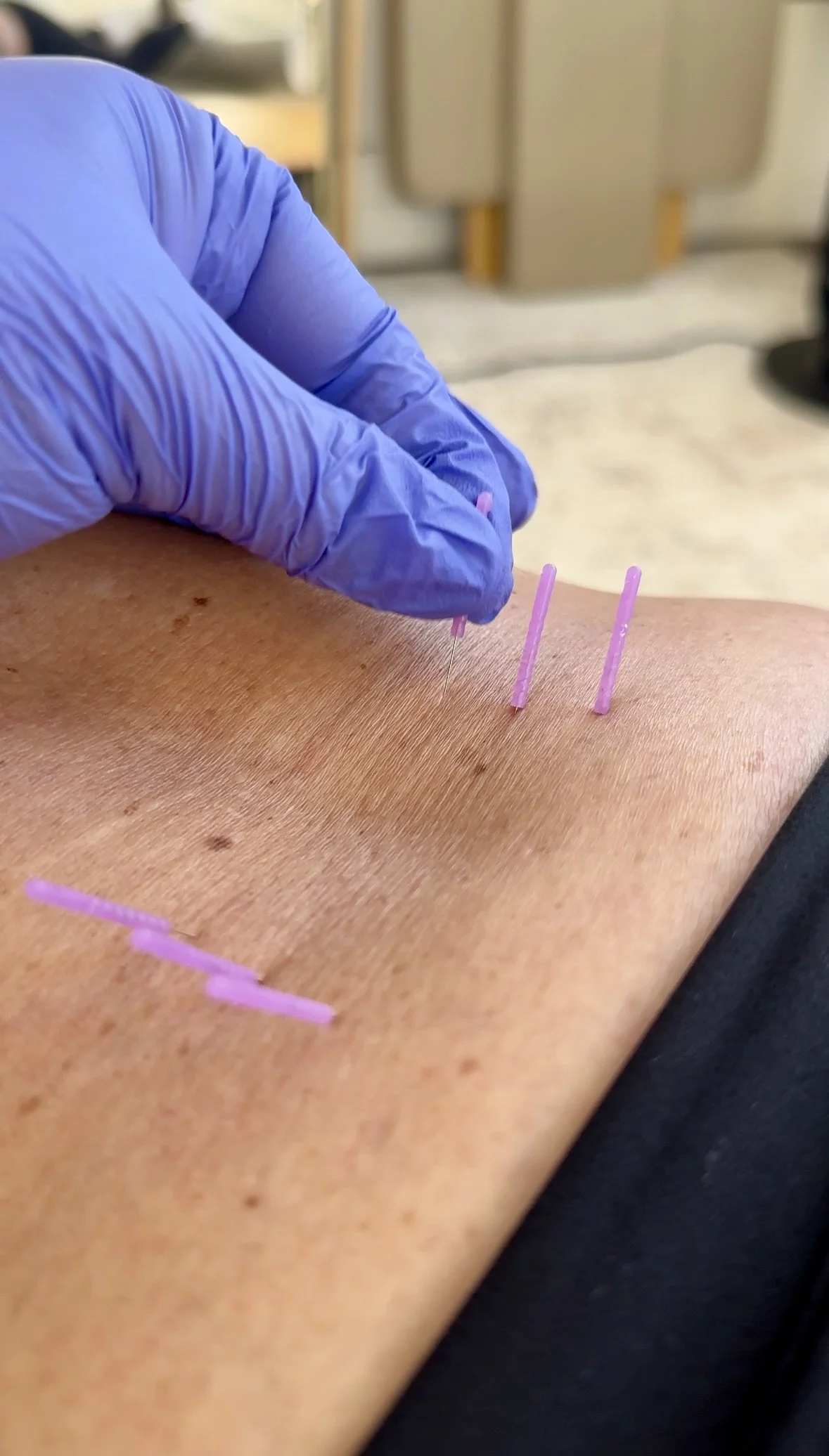 A healthcare professional is administering acupuncture, inserting fine needles into a person's skin on their arm.