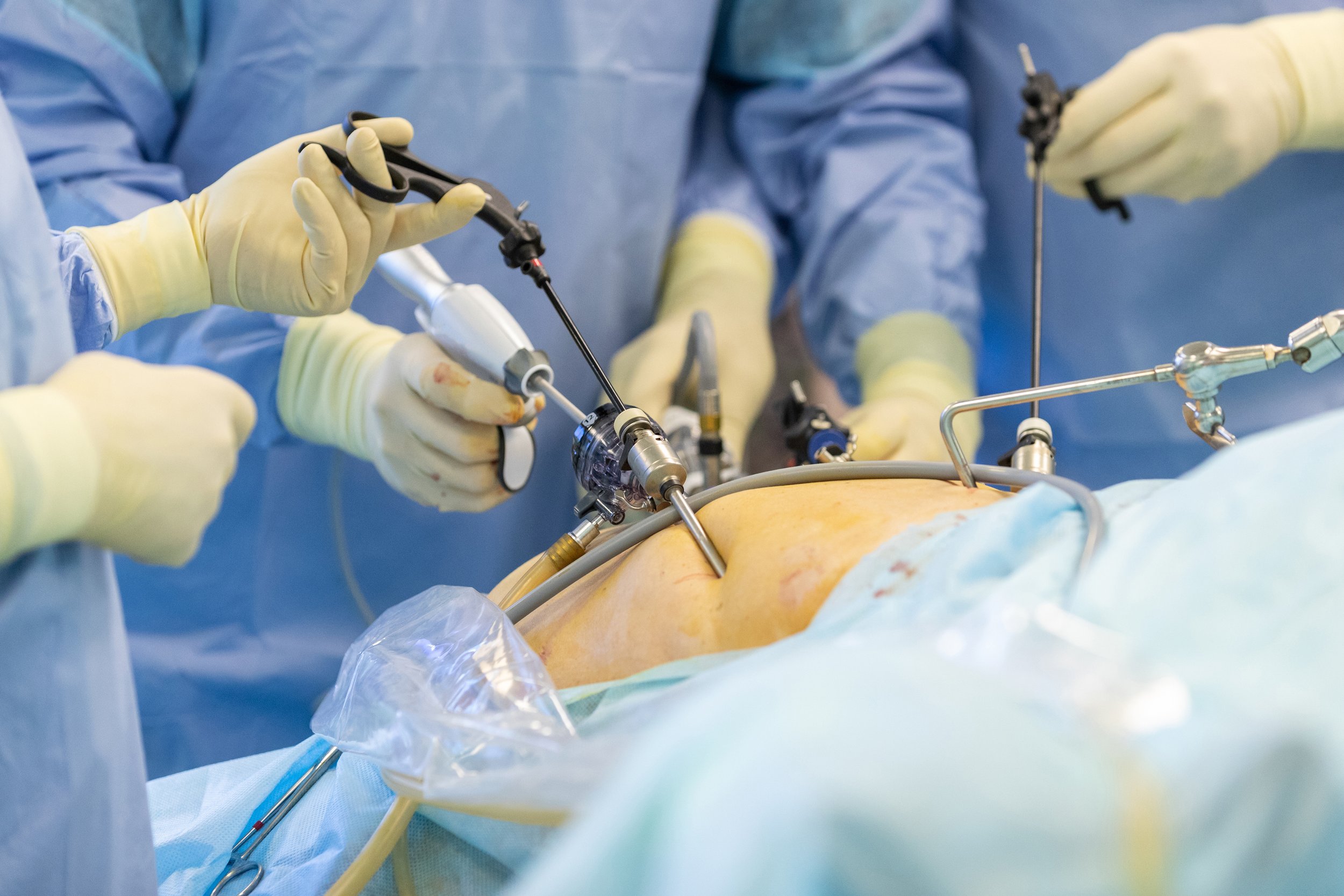 Laparoscopic Surgery - Dr Diss specialises in laparoscopic surgery, offering patients an alternative to traditional open procedures. 