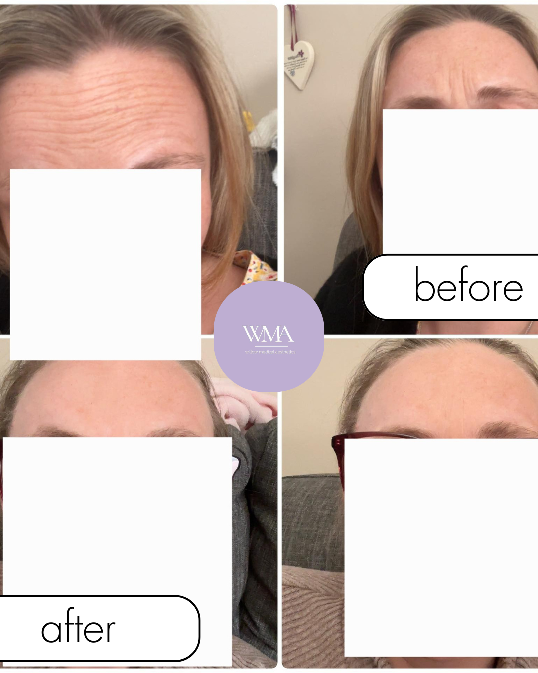 Botox - Two areas (Frown lines & Forehead)