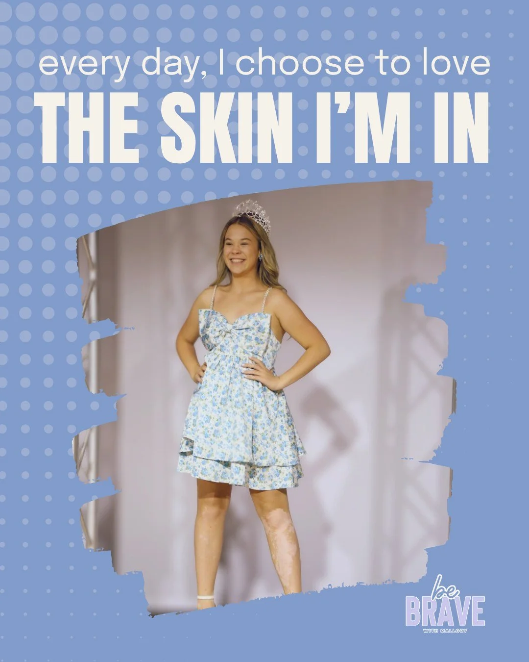 Acceptance of yourself isn't always easy. You have to choose every day to love yourself, embrace who you are, and be brave. We're in this together! 💪🏻
.
.
.
.
.
.
.
.
.
.
.
.
#Vitiligo #VitiligoAwareness #VitiligoBeauty #VitiligoCommunity #Vitiligo