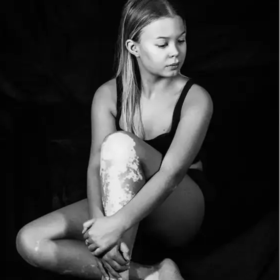 Mallory Posing for Vitiligo Photographer Sharolyn B. Hagen