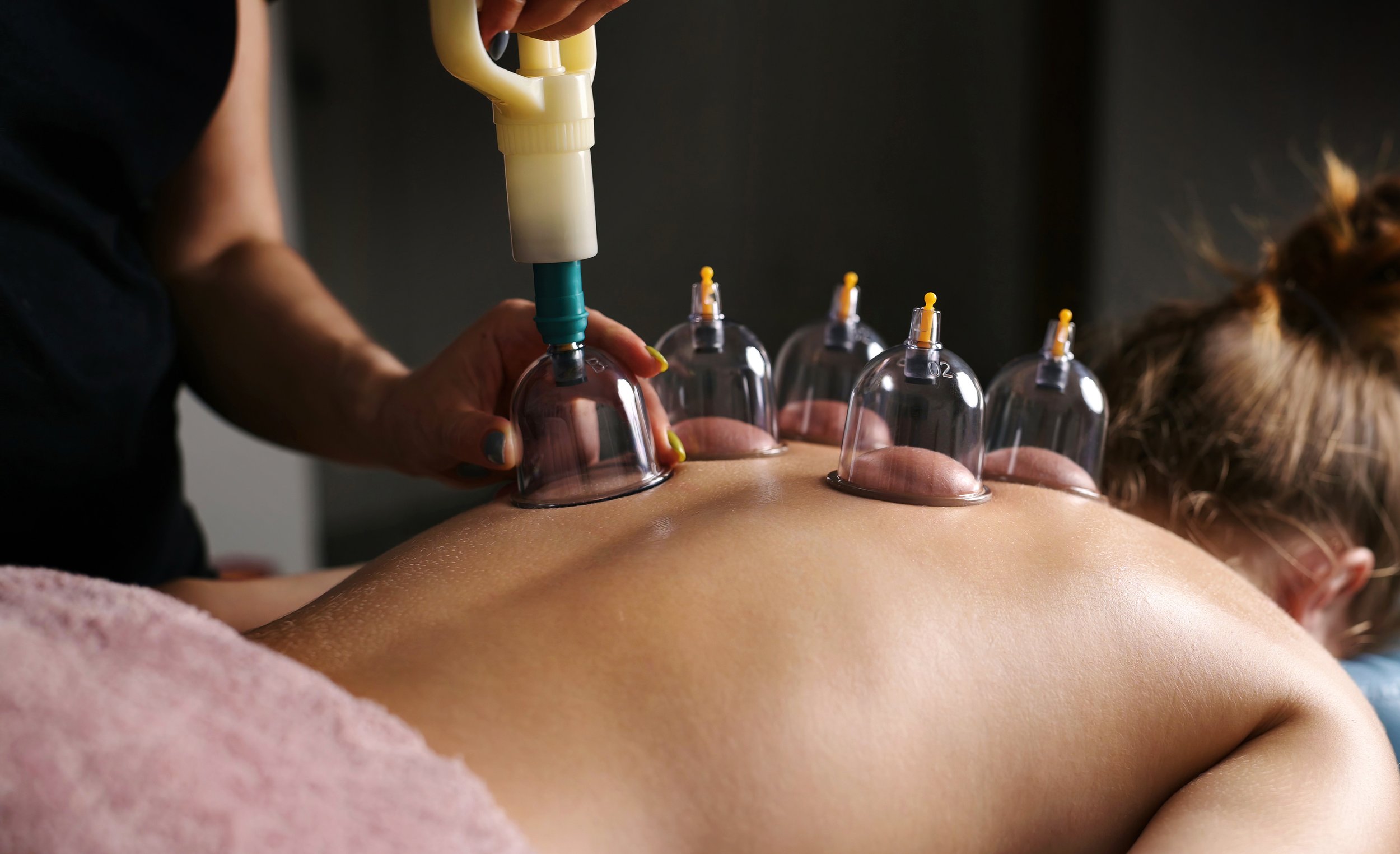 A person receiving acupuncture treatment on their back, with multiple tiny needles inserted along their spine, in a room with natural light and a window in the background.