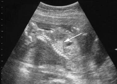 Ultrasound image showing a fetus with a congenital pulmonary airway malformation (CPAM).