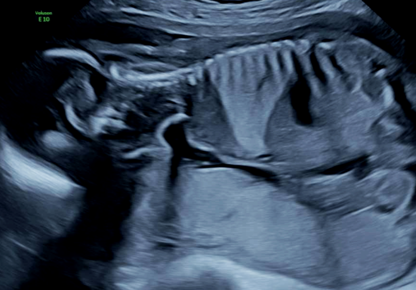 Prenatal ultrasound of bronchopulmonary sequestration BPS baby