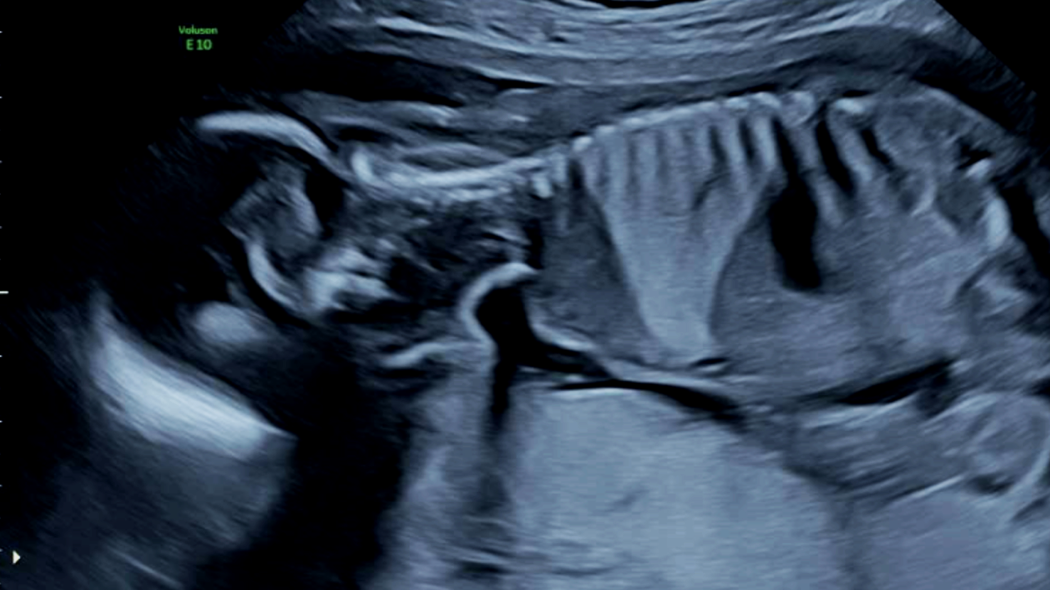 Prenatal ultrasound showing a congenital lung malformation