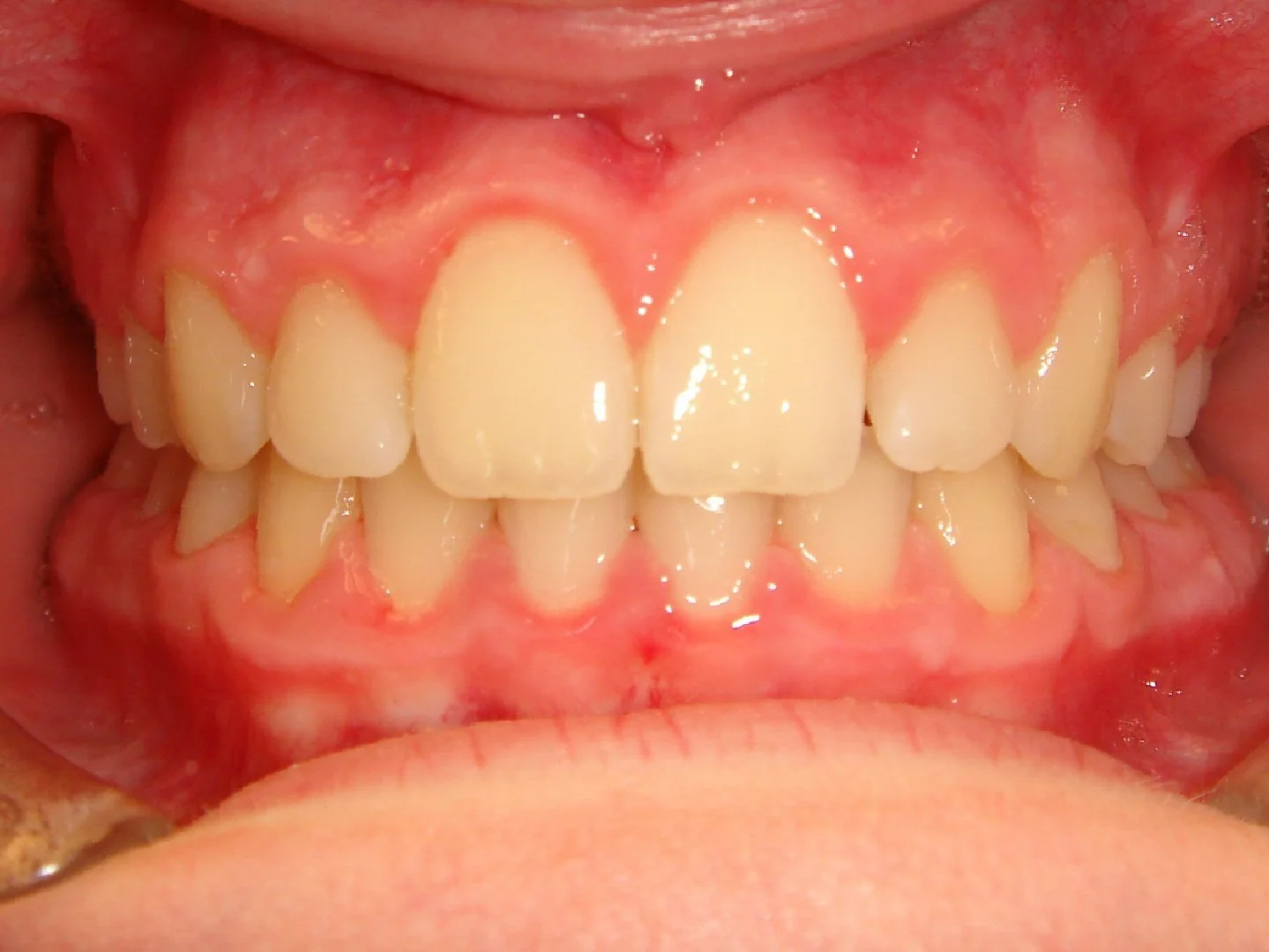 Close-up frontal view  of upper and lower straight teeth with ideal alignment.