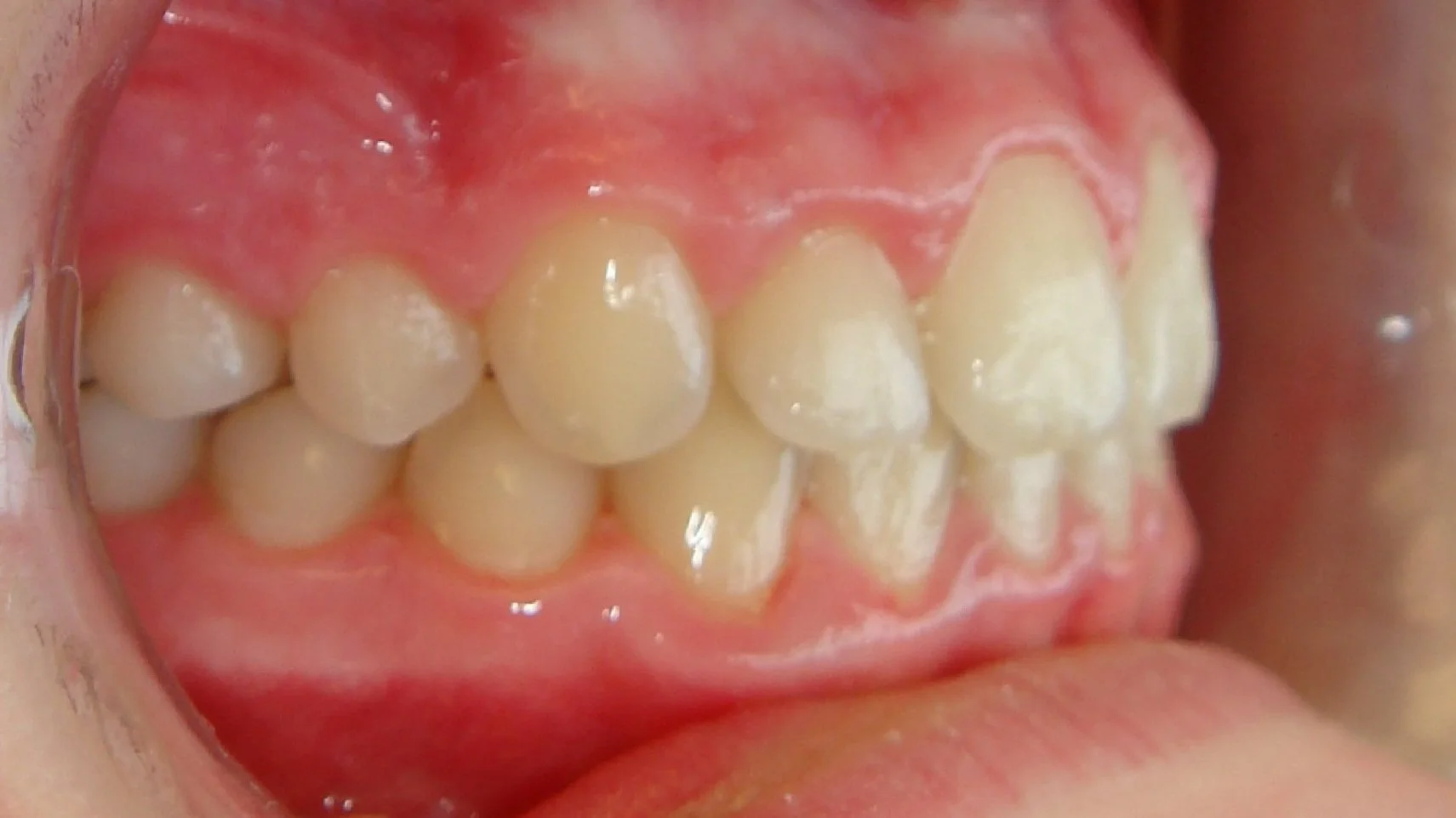 Close-up of a person's bite showing upper and lower teeth in perfect alignment.