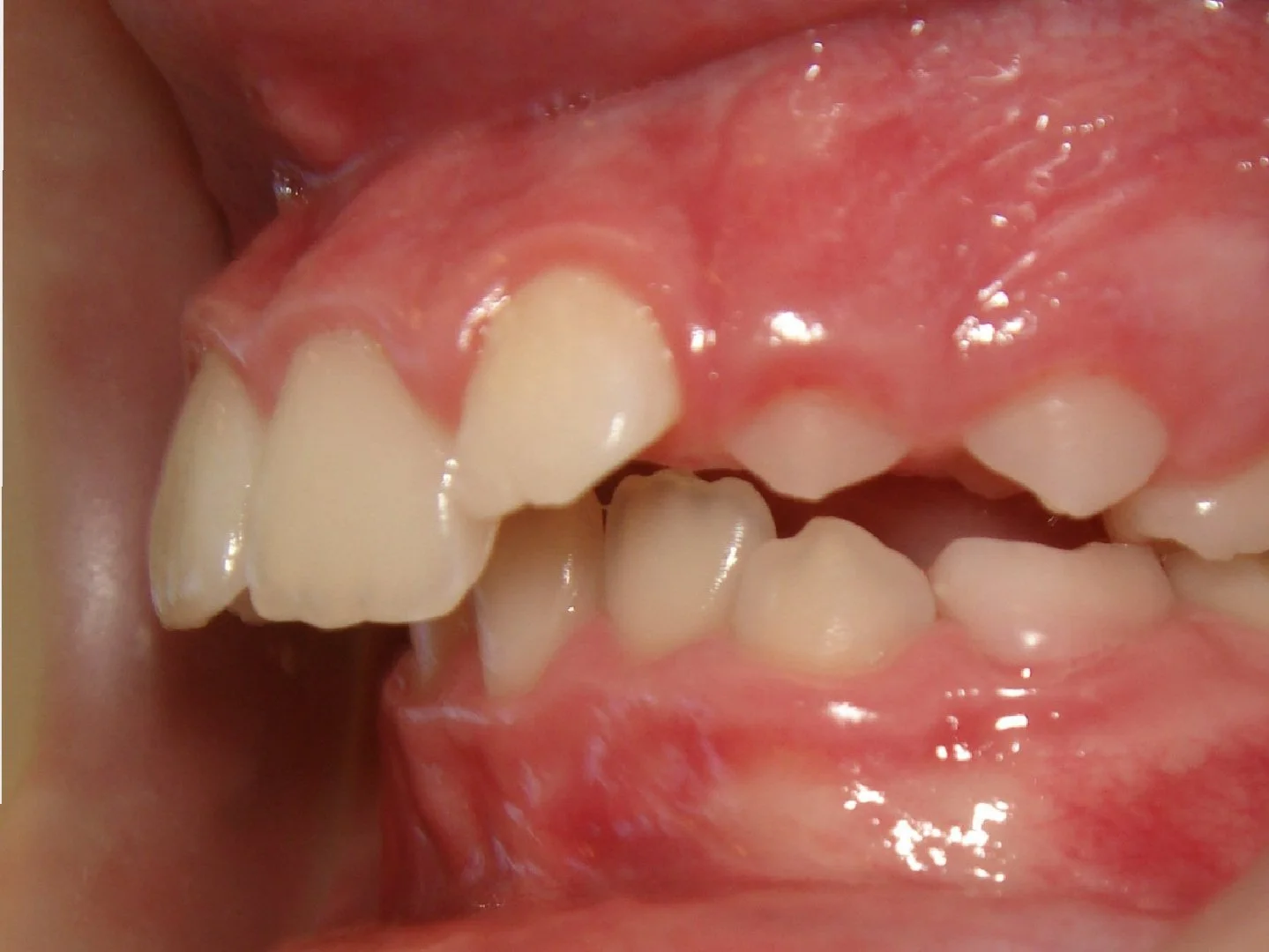 Close-up of a person's mouth showing crowded, misaligned and flared teeth.