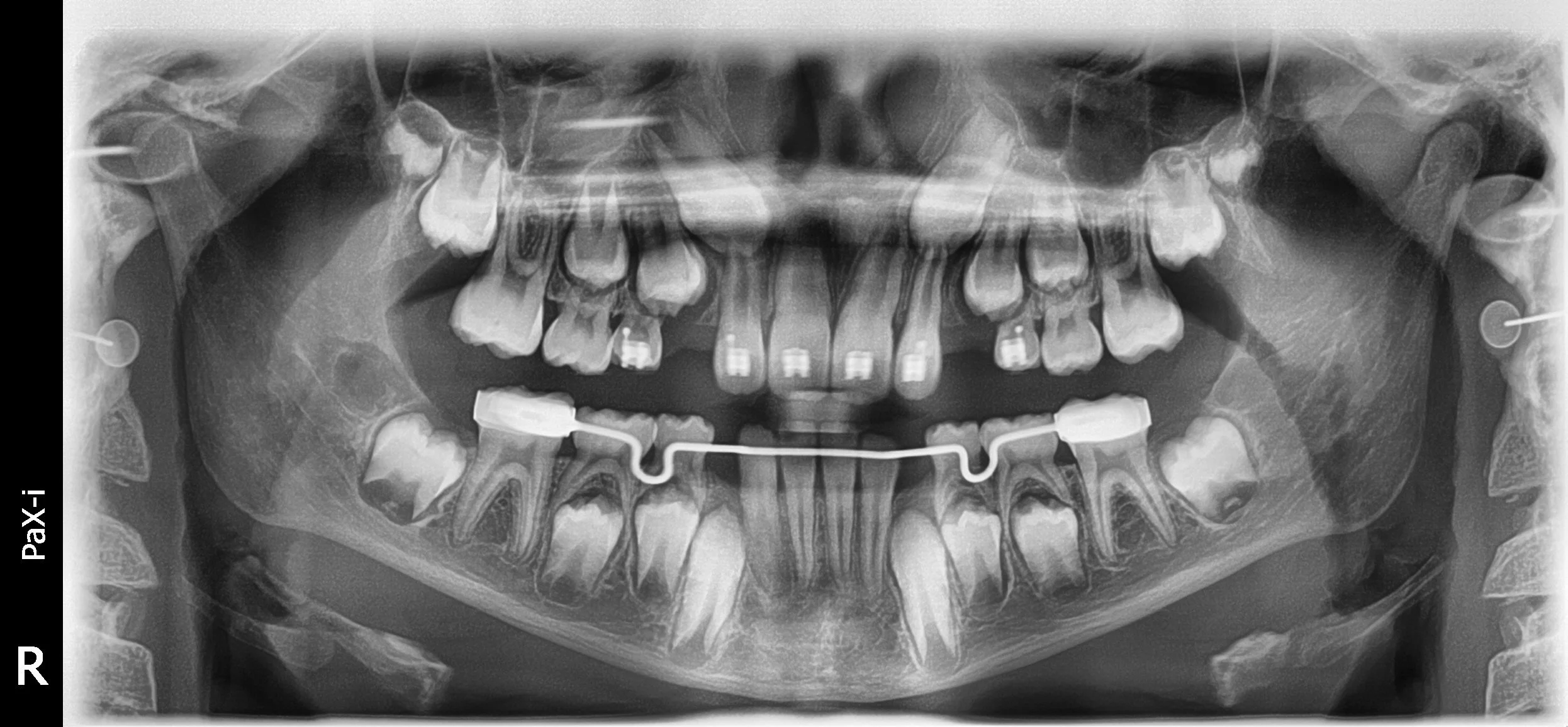 Panoramic X-ray image of a person's teeth showing orthodontic braces and impacted canines.