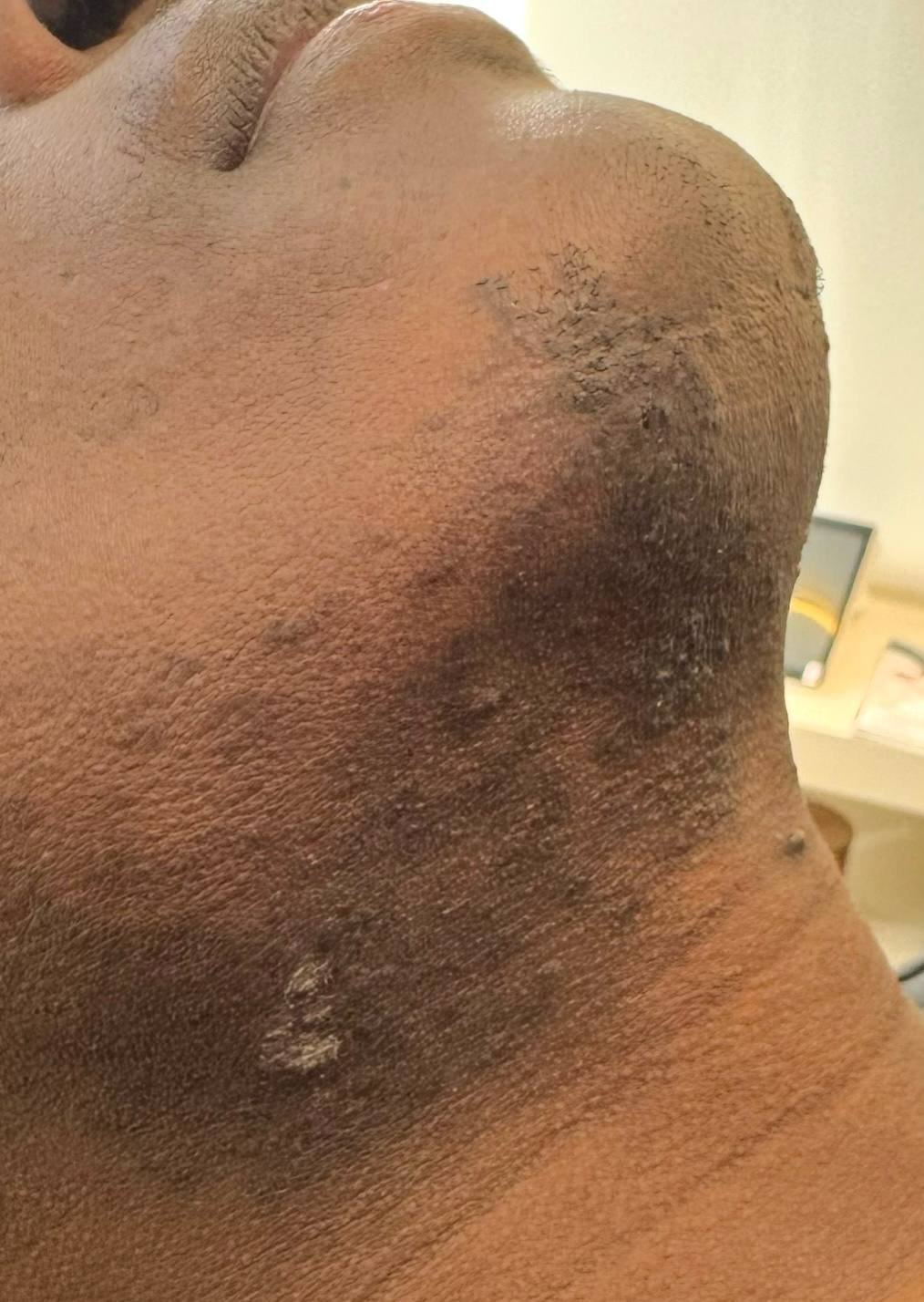 Zoom sur le cou d'une personne montrant des taches pigmentées et une peau épaissie avec des zones de dépigmentation