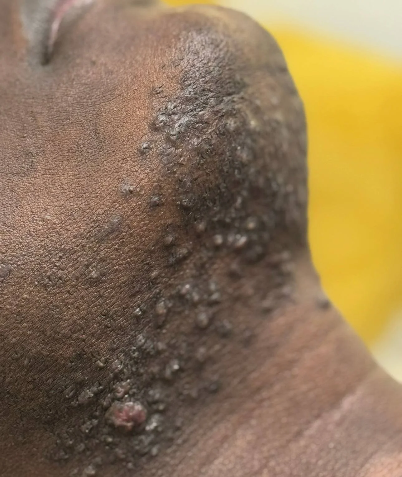 Une zone de peau avec plusieurs boutons, inflammations, poils incarnés et croûtes, suggérant une infection ou une irritation cutanée.