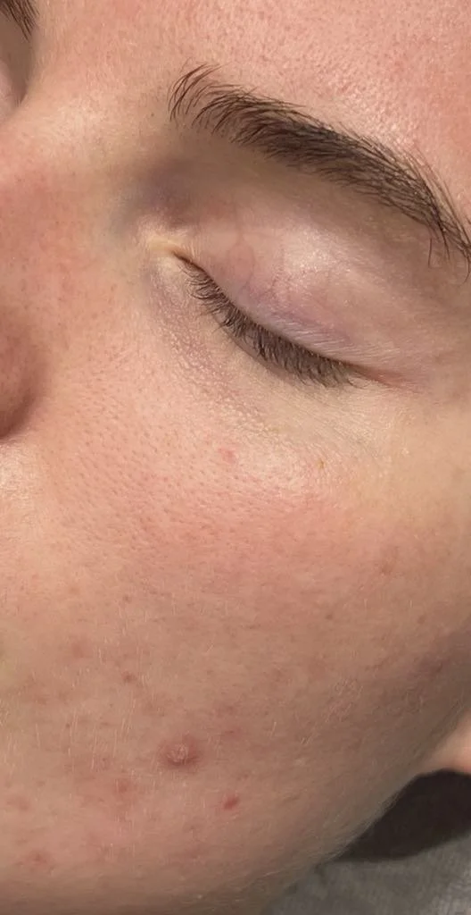 Zoom sur le visage d'une personne avec des pores visibles, quelques boutons et une peau claire