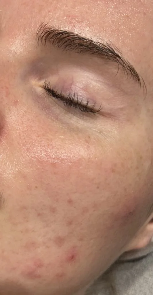 Close-up d'un visage avec une peau claire, quelques imperfections et boutons, l'œil fermé, sourcils bruns, peau légèrement rosée.