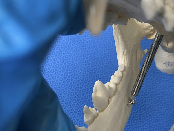 Figure 8B. Arrow indicates the mandibular foramen..png
