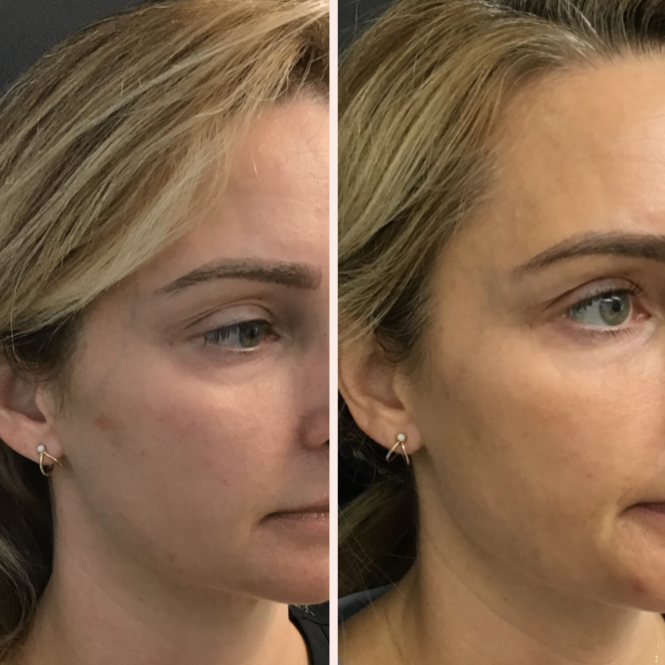 Woman with laser treatment