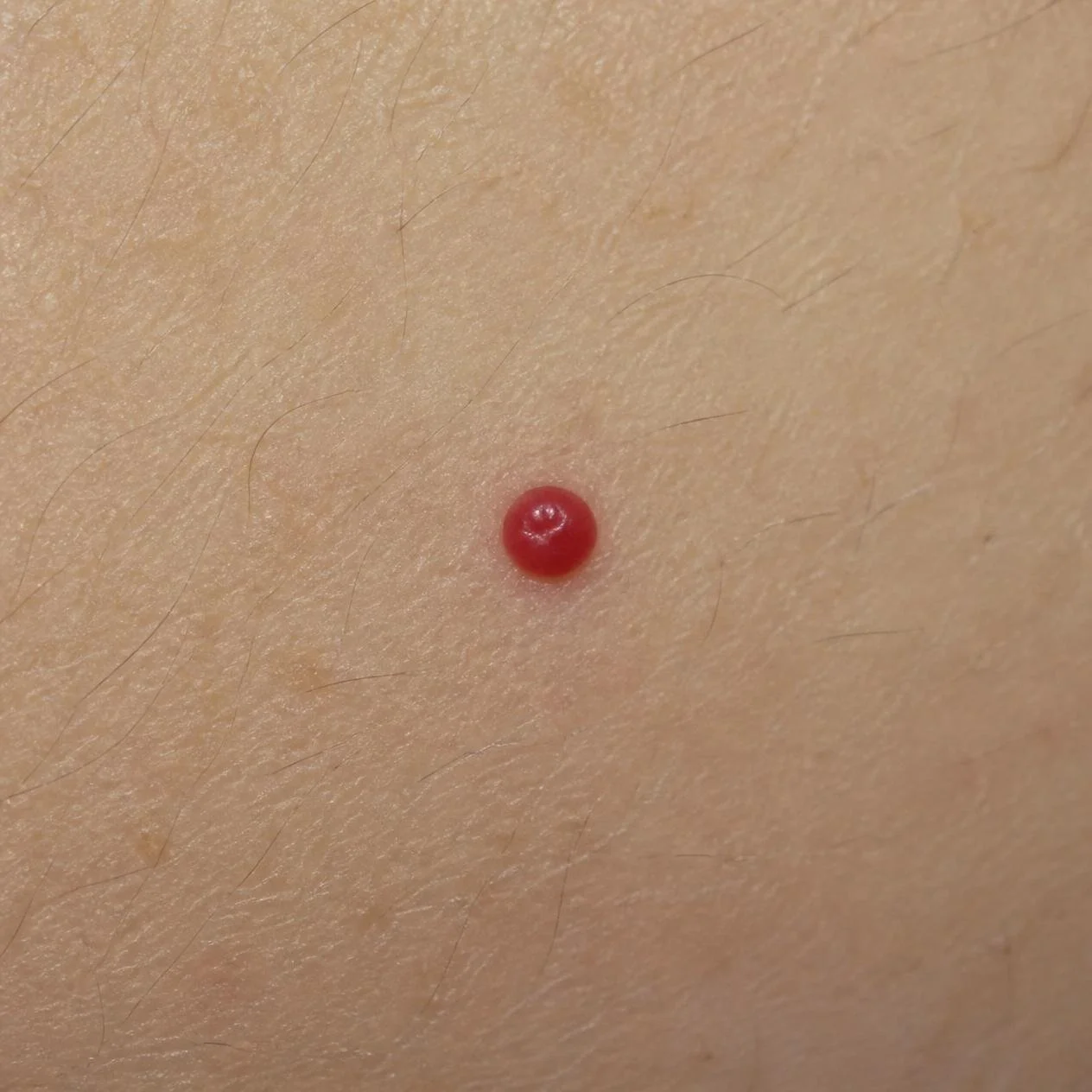 Angiomas appearing as small red vascular growths on the skin.