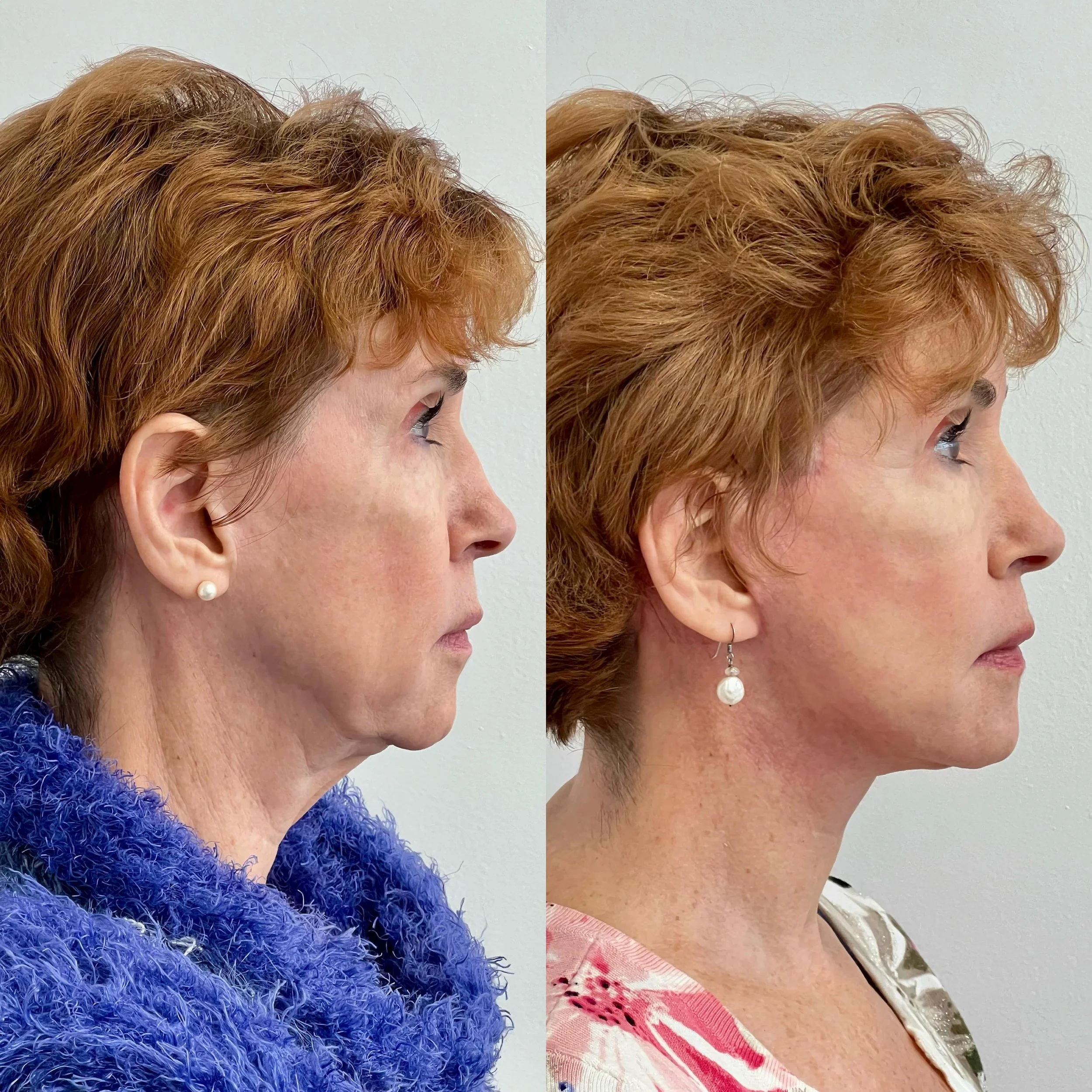 ✨ Witness the stunning results of our lower and neck lift procedure performed by the talented Dr. Dunn! ✨

Our expert team delivers natural, youthful rejuvenation that boosts confidence. Ready for your own transformation? Book a consultation today an