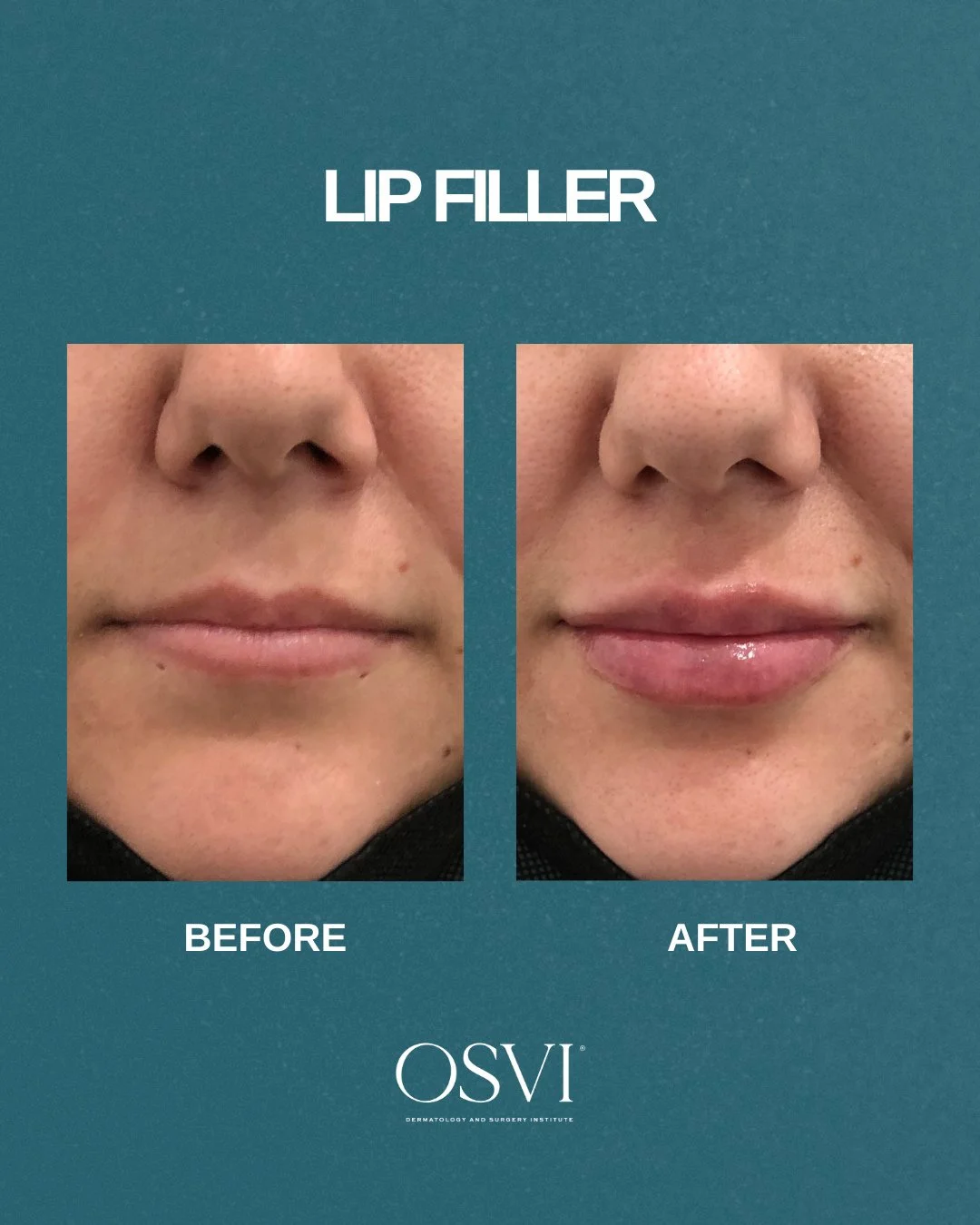 Lip filler should enhance what you already have, not change who you are. At OSVI, we focus on balance, proportion, and natural-looking results, using the right filler and the right amount for your lips. Subtle, thoughtful, and tailored, always. 💋 ⁠
