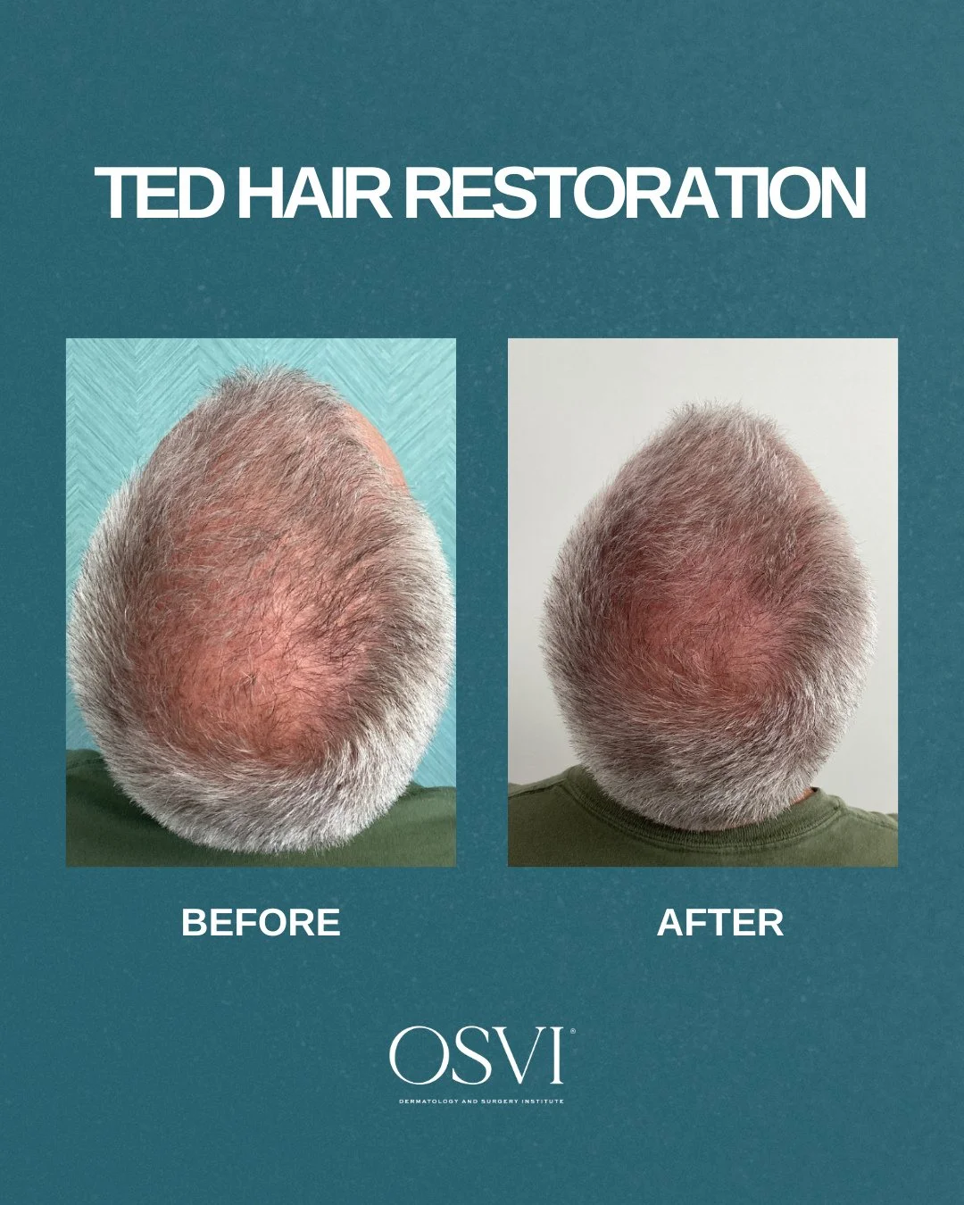 Proof that great hair days can make a comeback ✨ TED Hair Restoration is needle-free, non-invasive, and designed to wake up dormant follicles, no downtime required.⁠
⁠
Thinking about your own before &amp; after? Book your consultation today 📲