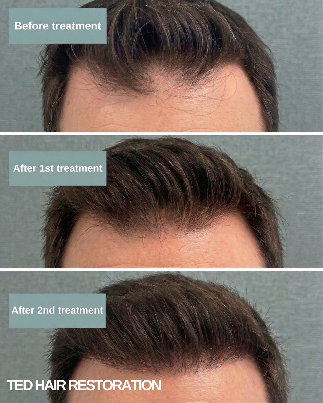 Real results, no needles.⁠
⁠
TED Hair Restoration uses advanced ultrasound technology to deliver hair growth ingredients directly into the scalp, helping support thicker, stronger, healthier hair without injections or downtime.⁠
⁠
It&rsquo;s no surpr