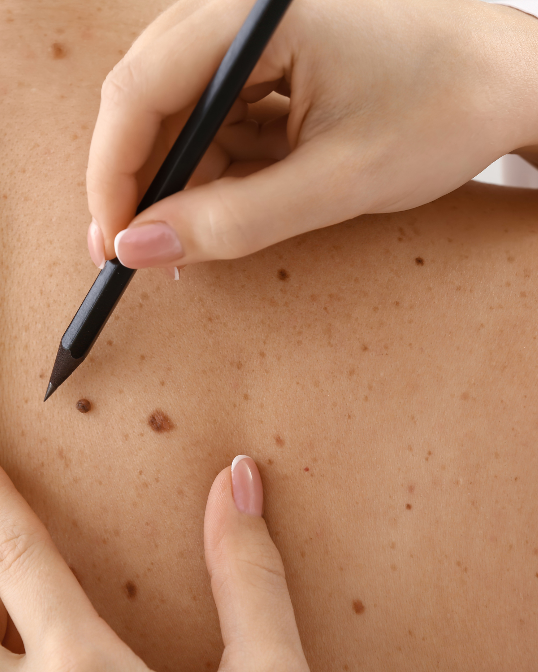 Skin Cancer Awareness: Early Signs You Should Never Ignore