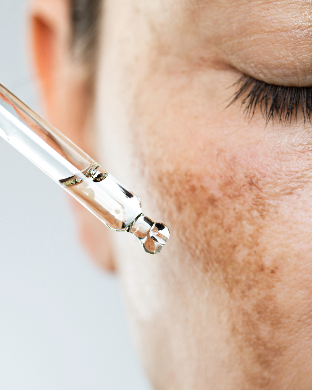 The Best Treatments for Hyperpigmentation in 2026