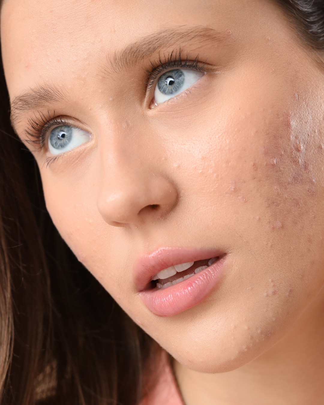 How to Get Rid of Acne Scars (Without Overdoing It)