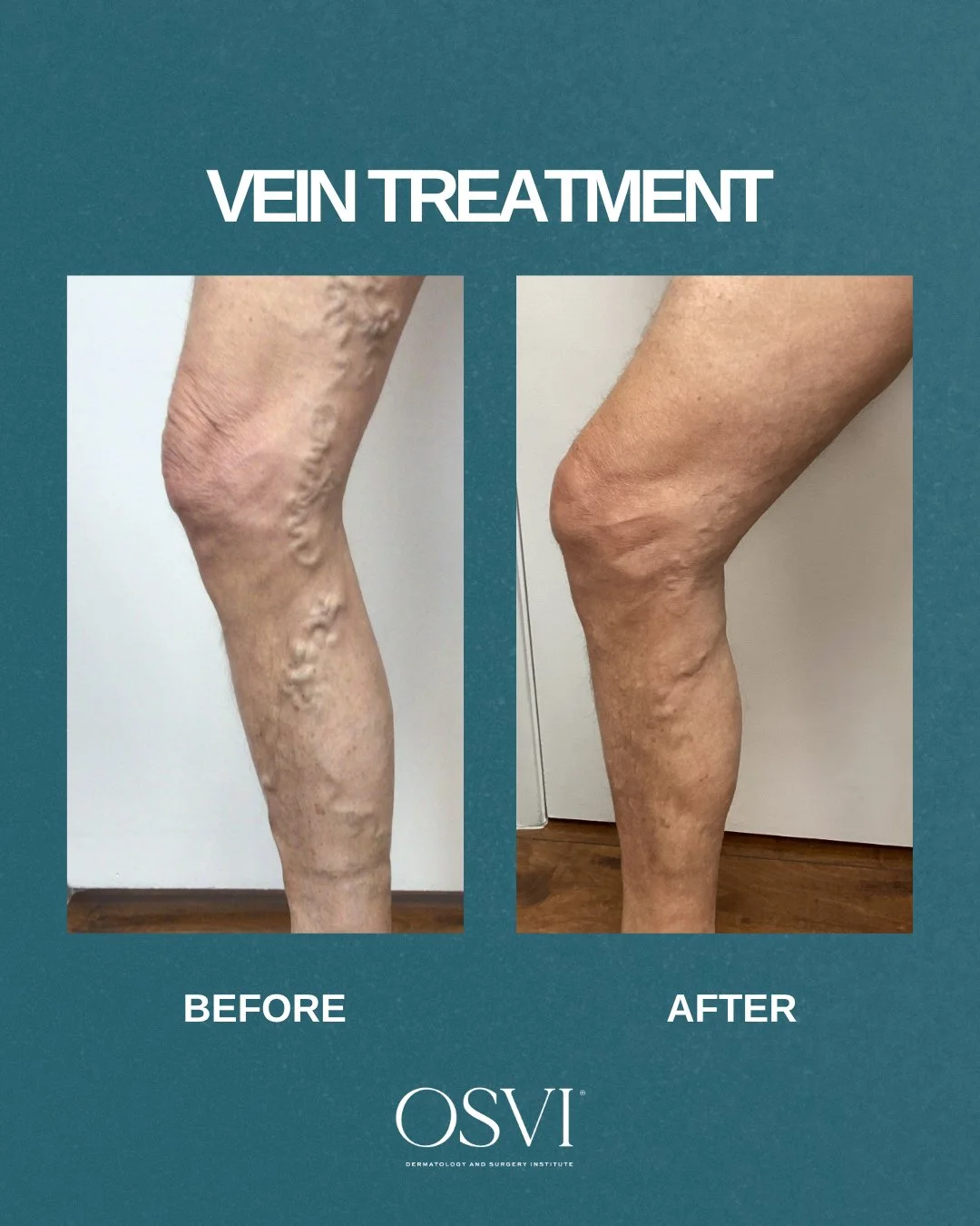Varicose veins aren&rsquo;t just cosmetic, they&rsquo;re a sign of underlying circulation changes.⁠
⁠
That&rsquo;s why every treatment we perform is fully personalized, designed to improve vein health and restore a smoother, more refined appearance ?