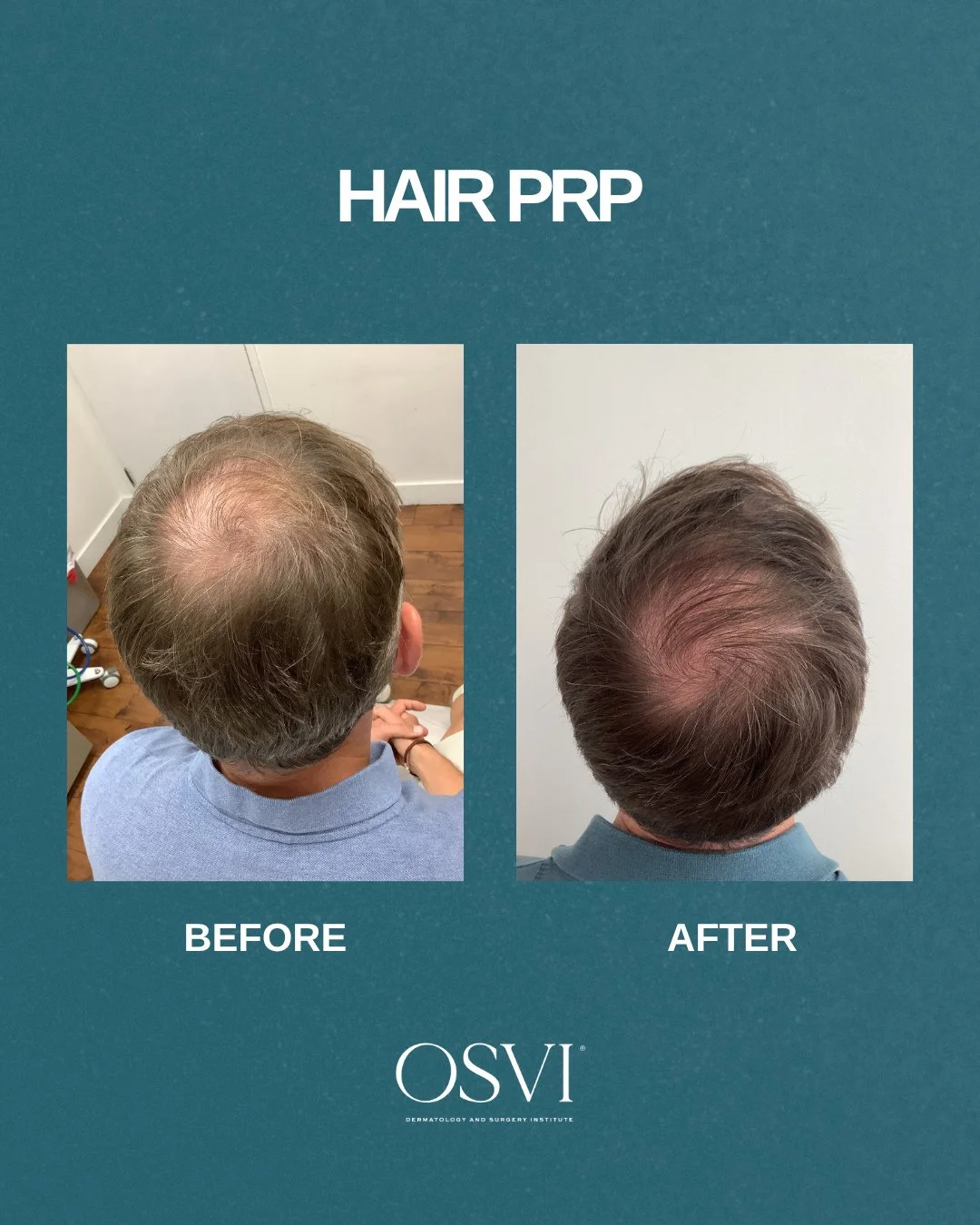These results speak for themselves 🤍 PRP works by concentrating your own growth factors and injecting them directly into the scalp to stimulate dormant follicles and support real, lasting regrowth. No surgery, no downtime, just results.⁠
⁠
Link in b