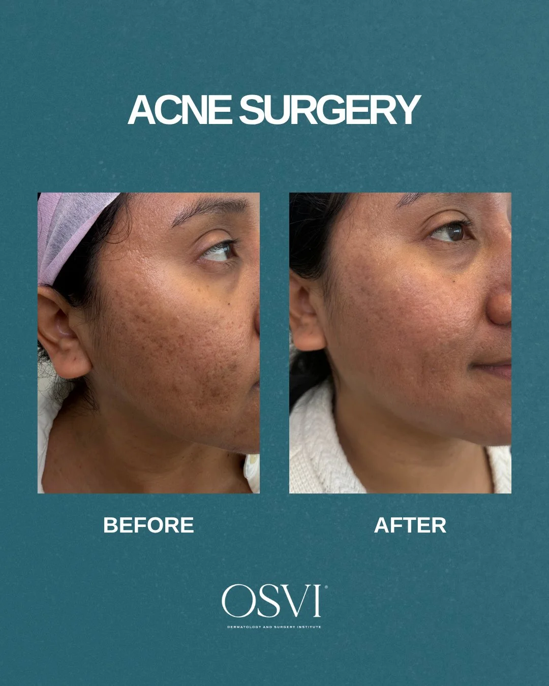 Clearer, smoother, and more even, this is what treating acne scars at the source actually looks like ✅️⁠
⁠
If acne scarring is something you've been struggling with, this one's for you. Link in bio to book your consultation 📲