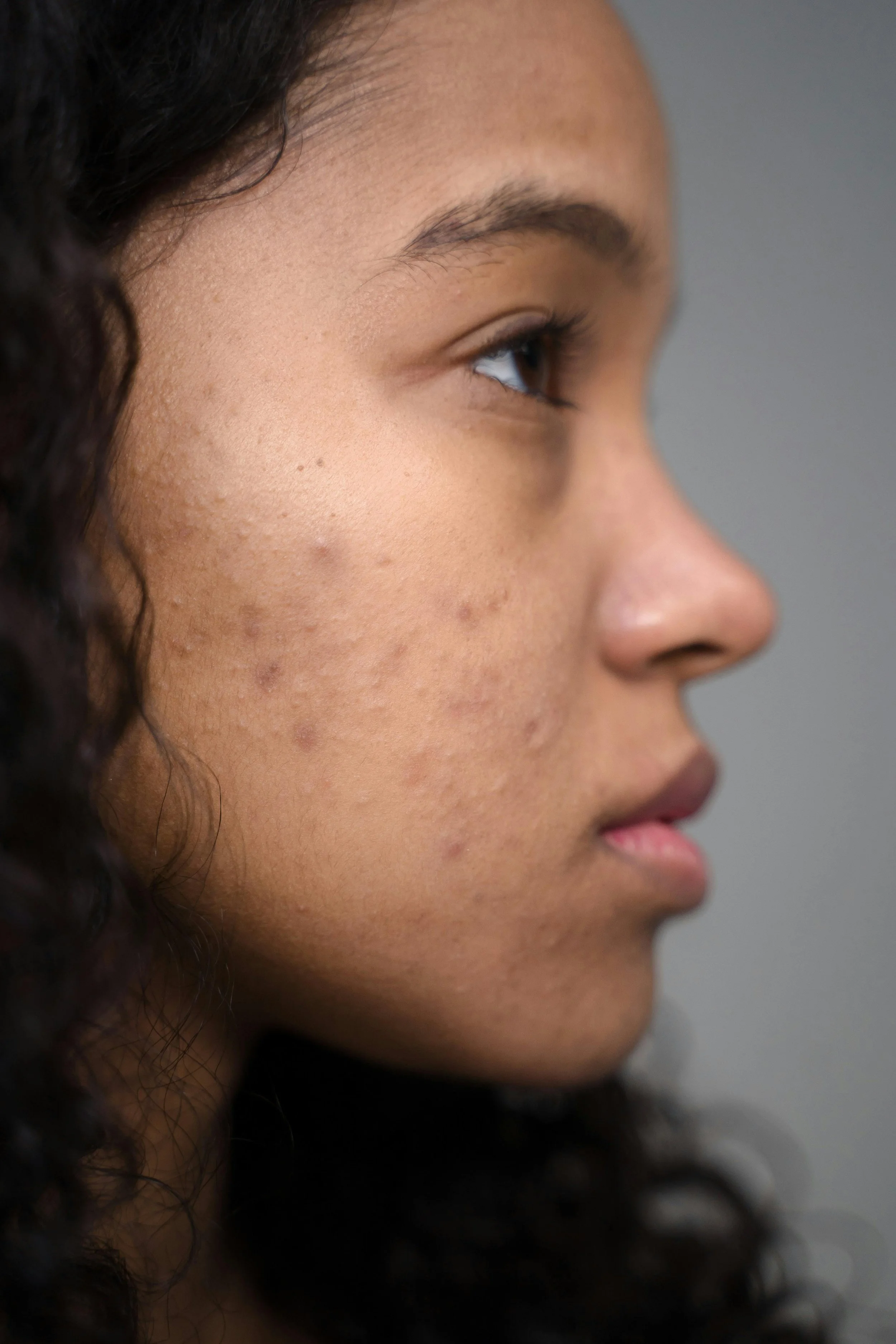 Holiday Stress &amp; Your Skin: Why December Causes Breakouts, Redness &amp; Flare-Ups