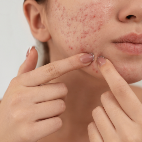 How Board-Certified Dermatologists Treat Stubborn Acne