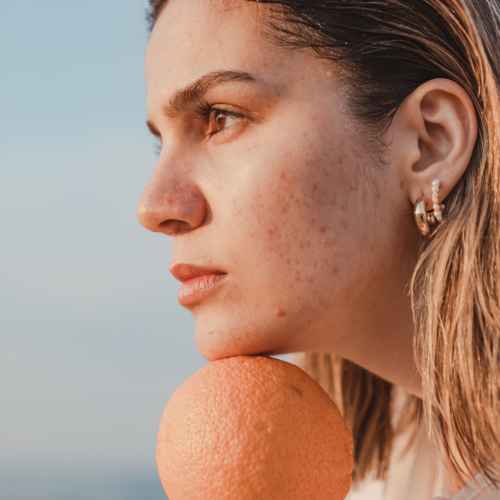 Can Diet Really Cause Acne? What Dermatologists Want You to Know