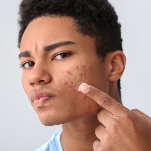 Acne Scars: What Causes Them and How to Treat Them