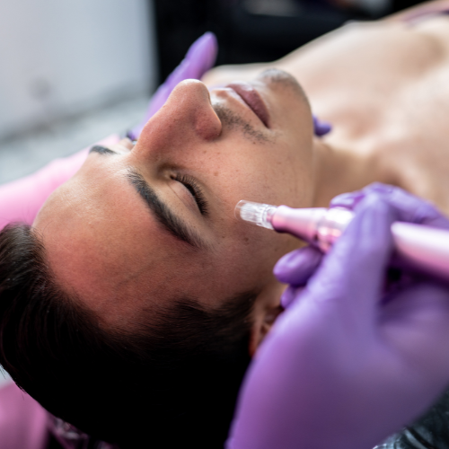 Microneedling for Acne Scars: Benefits and Results