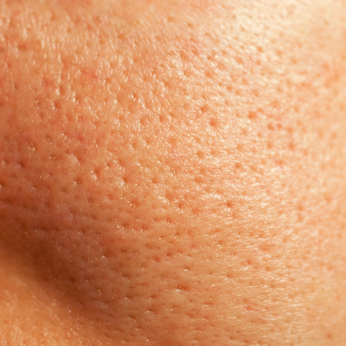 The Truth About Enlarged Pores and How to Minimize Them