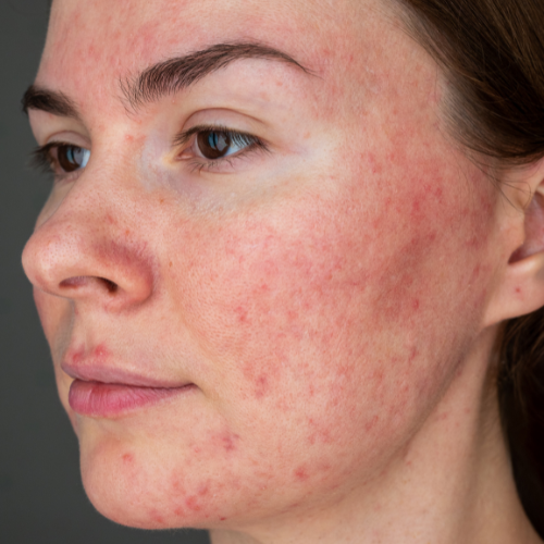 Rosacea vs. Acne: How to Tell the Difference